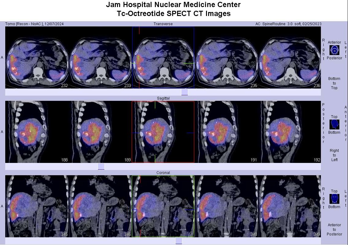Octreotide SPECT-CT